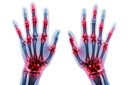 Estatinas não foram relacionadas com artrite reumatoide, observando-se riscos atenuados após ajuste para níveis de lipídios